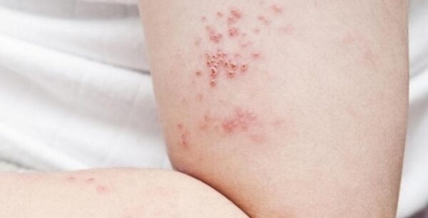 Έρπης ζωστήρ: Ποια είναι τα συμπτώματα – Τι πρέπει να κάνετε
