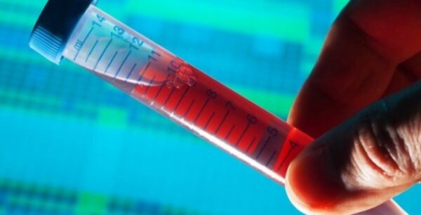 «Δεν υπάρχει εξέταση αίματος που να υποκαθιστά την αμνειοπαρακέντηση»