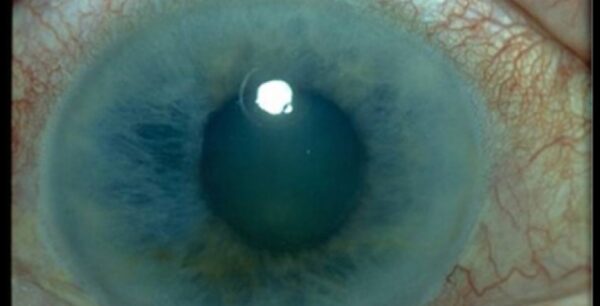 Γλαύκωμα: ο ύπουλος εχθρός των ματιών μας