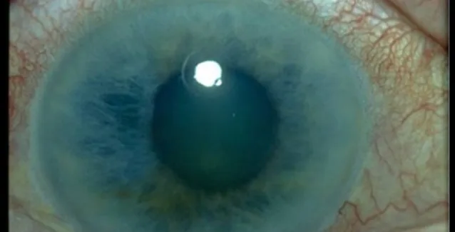 Γλαύκωμα: ο ύπουλος εχθρός των ματιών μας