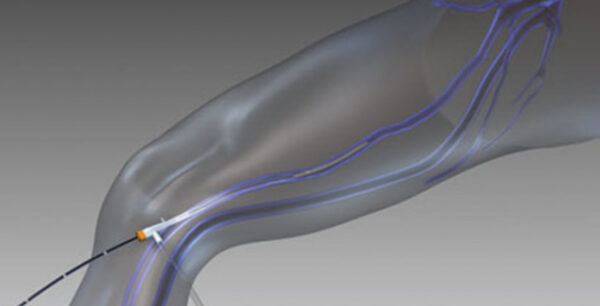 Η φλεβίτιδα δεν είναι μόνο πρόβλημα εμφάνισης αλλά και υγείας