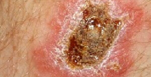 Εκτός από τον Έμπολα και Λεϊσμανίαση στη Μέση Αντολή, λόγω εμπόλεμων καταστάσεων-Απειλή για την Νότια Ευρώπη