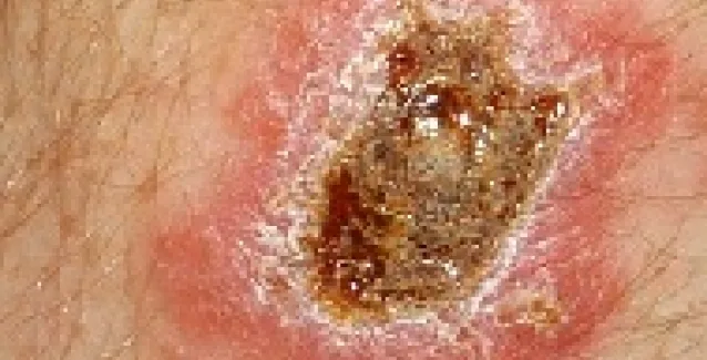 Εκτός από τον Έμπολα και Λεϊσμανίαση στη Μέση Αντολή, λόγω εμπόλεμων καταστάσεων-Απειλή για την Νότια Ευρώπη