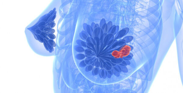 Καρκίνος μαστού: Τα σύγχρονα όπλα στην πρόληψη και τη θεραπεία του