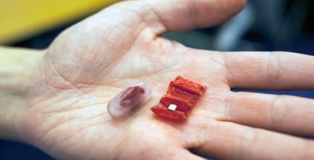 Το ρομπότ που το καταπίνεις και μπορεί να σου σώσει τη ζωή