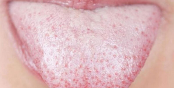 Λευκή γλώσσα: Πότε πρέπει να σας ανησυχήσει