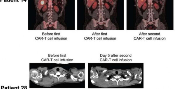 Αντικαρκινική ανοσοθεραπεία θεράπευσε πλήρως ασθενείς με προχωρημένο λέμφωμα
