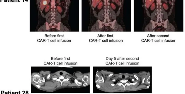 Αντικαρκινική ανοσοθεραπεία θεράπευσε πλήρως ασθενείς με προχωρημένο λέμφωμα