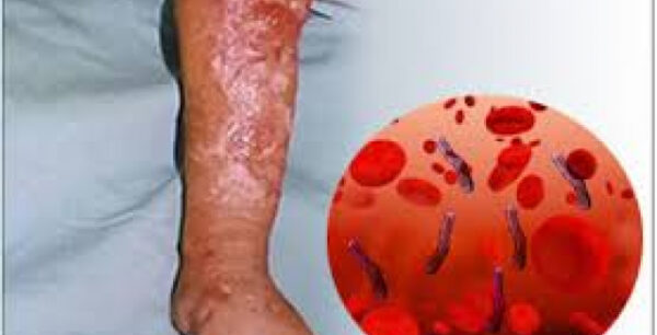 100.000 Έλληνες δίνουν μάχη κάθε χρόνο με τη σηψαιμία