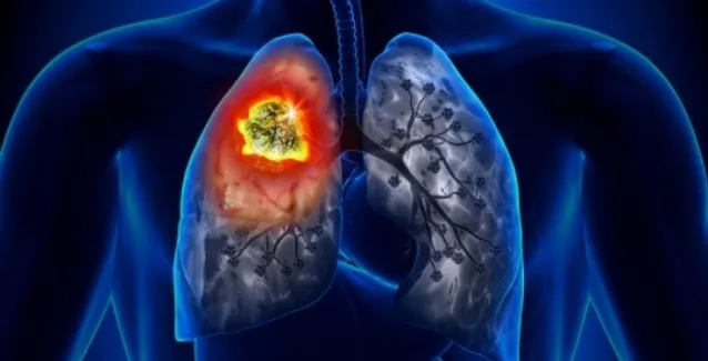 Ο καρκίνος αυτός δεν παρουσιάζει συμπτώματα: Είναι όμως η πρώτη αιτία θανάτου παγκοσμίως!