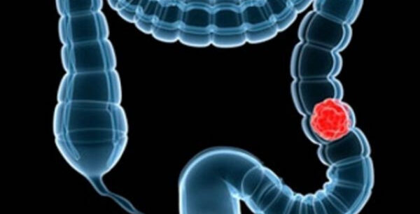 Έρευνα: Το κοινό βακτήριο E.coli μπορεί να εμπλέκεται στον καρκίνο του εντέρου