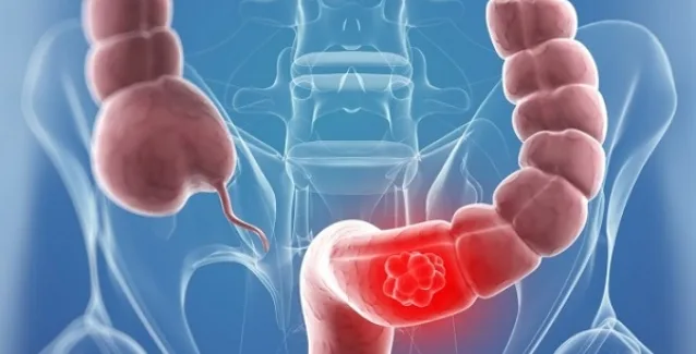 Καρκίνος του παχέος εντέρου: Ποια είναι τα πρώιμα συμπτώματα