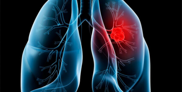 Καρκίνος πνεύμονα: Μεγαλύτερη επιβίωση για τους χειρουργημένους ηλικιωμένους ασθενείς