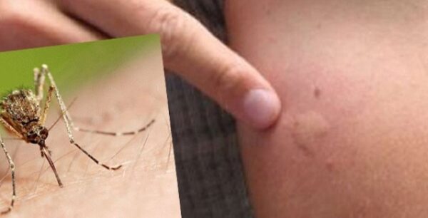 Προσοχή! Κρούσμα λεϊσμανίασης στην Κρήτη. Τι είναι πως μεταδίδεται