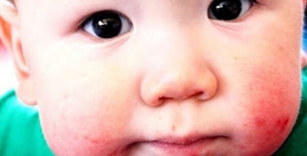 Μεγάλη προσοχή: Σε έξαρση ο ιός Κοξάκι. Τι πρέπει να γνωρίζουν οι μαμάδες;