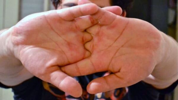 Δείτε τι μπορεί να προκαλέσει το “κράκ” που κάνουμε με τα δάχτυλα μας…