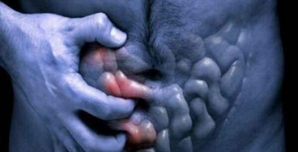 Αυτά είναι τα πρώτα σημάδια για τη νόσο Crohn