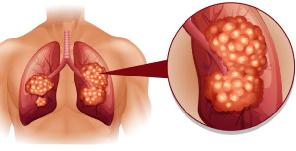 Καρκίνος του πνεύμονα: 8 σημάδια που πρέπει να γνωρίζετε