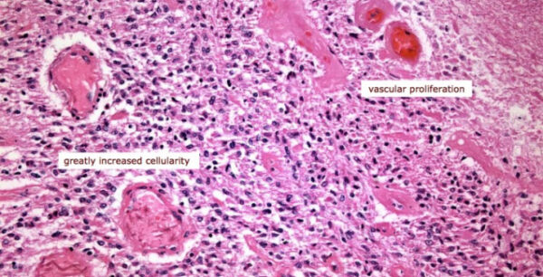 Γλοιοβλάστωμα. Τι μπορεί να εμποδίσει την εξάπλωσή του