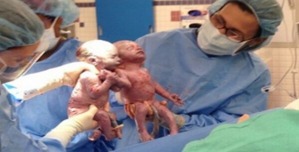 Οχάϊο: Χέρι-χέρι ενωμένα δίδυμα ήρθαν στον κόσμο