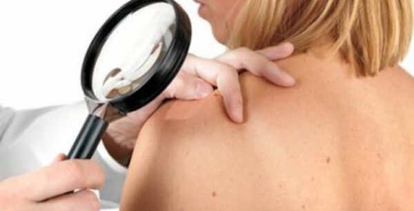 Δωρέαν εξετάσεις για καρκίνο του δέρματος με αφορμή την αυριανή Ευρωπαϊκή Ημέρα Μελανώματος