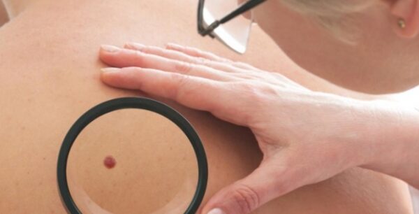 Δωρεάν εξετάσεις για τον Καρκίνο του Δέρματος και το Μελάνωμα