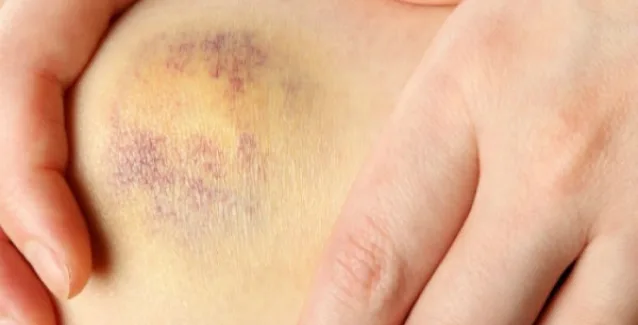 Κάνετε μελανιές χωρίς λόγο, ποιες είναι οι αιτίες