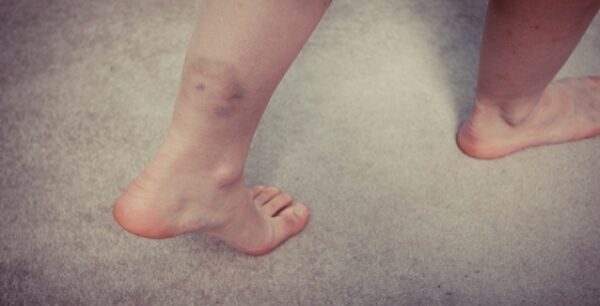 Ανεξήγητες μελανιές: Τι δείχνουν