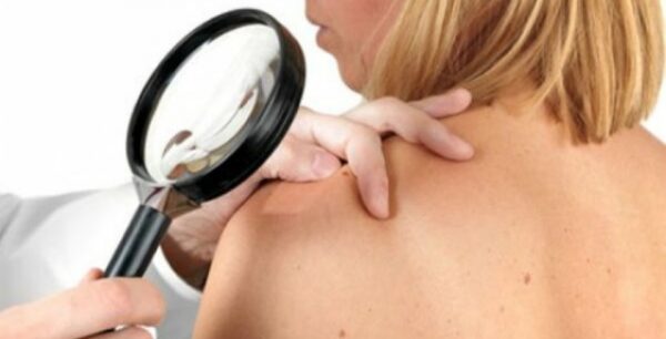 Μελάνωμα: Ποιοι παράγοντες βοηθούν στην εμφάνιση της πιο επιθετικής μορφής καρκίνου