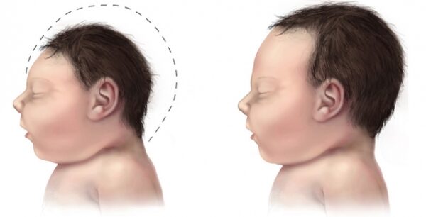 Ο Ζίκα στην Ευρώπη!