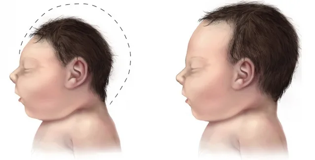 Ο Ζίκα στην Ευρώπη!