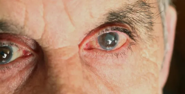 Προς θεραπεία καταρράκτη με οφθαλμικές σταγόνες η επιστημονική έρευνα