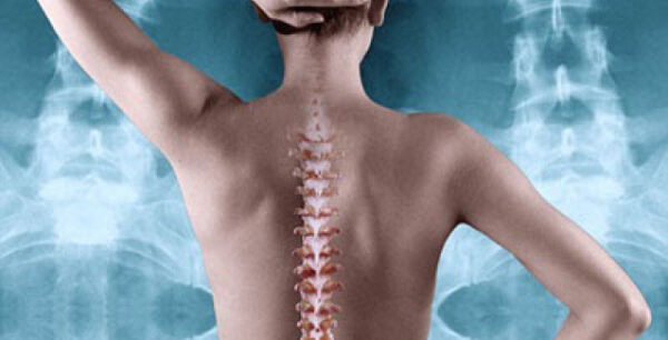 Η οστεοπόρωση αυξάνεται ανησυχητικά στην Ελλάδα της κρίσης.