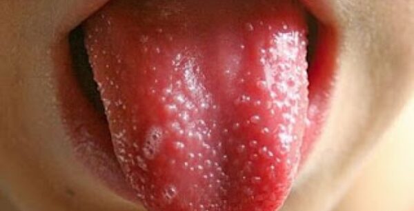 Οστρακιά: Συμπτώματα, θεραπεία και τρόποι πρόληψης