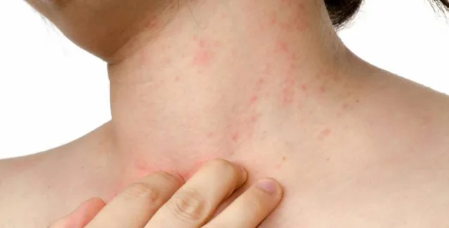 Τί να κάνετε για να περιορίσετε τα συμπτώματα της ψωρίασης