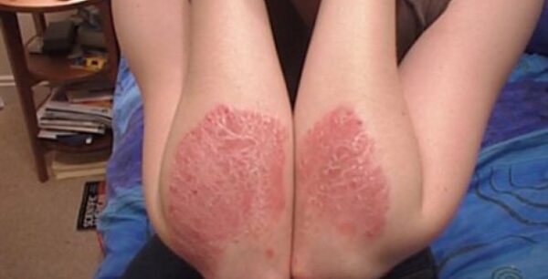 Διαθέσιμη στην Ελλάδα νέα θεραπεία για την ψωρίαση και την σπονδυλοαρθρίτιδα