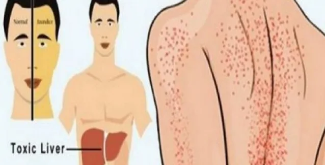 Μην τα αγνοείτε: Αυτά είναι τα 12 συμπτώματα που δείχνουν ότι το συκώτι σας έχει πρόβλημα!