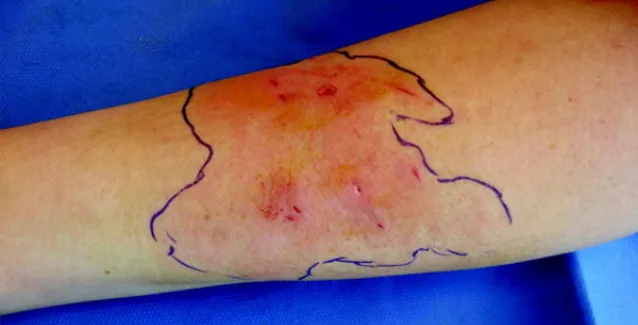 Σταφυλόκοκκος: Πώς θα ξέρετε ότι έχετε μολυνθεί – Τα σημάδια με εικόνες