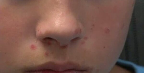 Ιός Κοξάκι: Πώς θα τον εντοπίσετε εγκαίρως στο παιδί