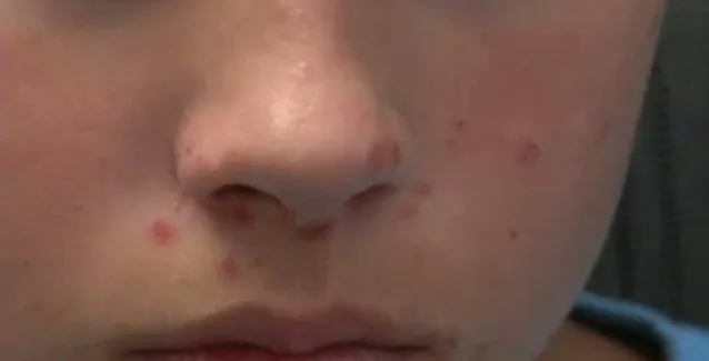 Ιός Κοξάκι: Πώς θα τον εντοπίσετε εγκαίρως στο παιδί