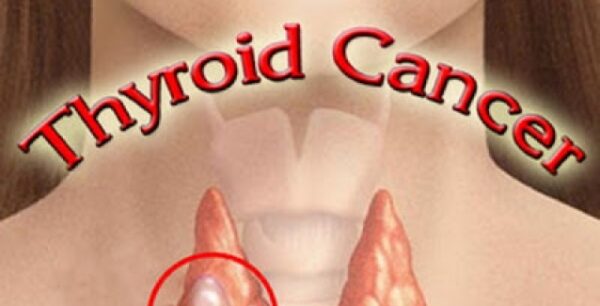 Ποια είναι τα συμπτώματα και ποιες οι αιτίες που εκδηλώνει καρκίνο ο θυρεοειδής;