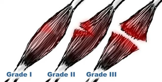 Τι είναι οι μυϊκές θλάσεις και πώς αντιμετωπίζονται