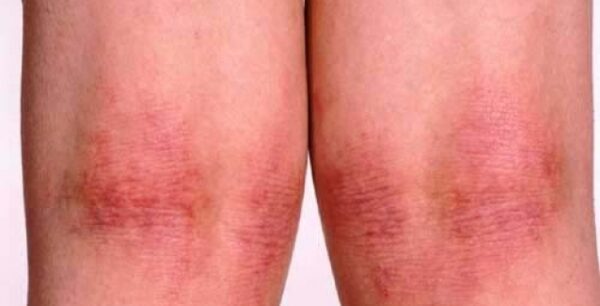 Η Ατοπική δερματίτιδα στα παιδιά:Συμπτώματα και αντιμετώπιση