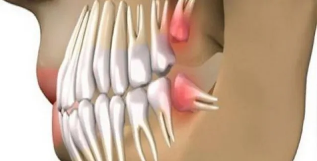 Πείτε αντίο στα οδοντικά εμφυτεύματα και μεγαλώστε τα δικά σας δόντια μέσα σε 9 εβδομάδες