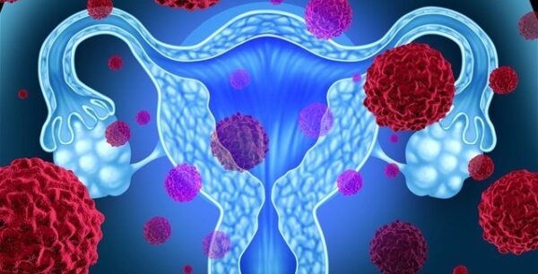 Καρκίνος του τραχήλου: Ευκολότερες εξετάσεις μπορεί να αντικαταστήσουν το τεστ ΠΑΠ