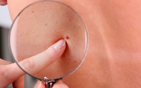 Υγεία  ; Οι γιατροί προειδοποιούν για το σπυράκι που… σκοτώνει [photo]