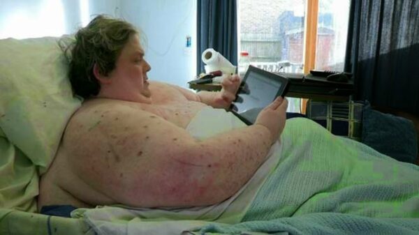 Εικόνες που προκαλούν σοκ! Δείτε πως είναι οι ακτινογραφίες ενός ανθρώπου 445 κιλών [photos + video]