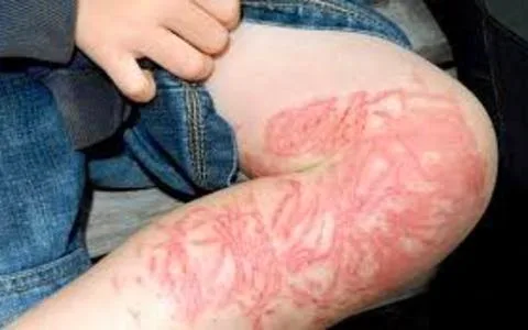 Νομίζετε ότι ξέρετε τι πρέπει να κάνετε αν σας τσιμπήσει τσούχτρα;