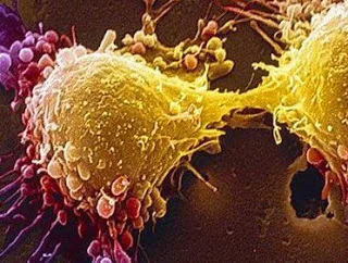 Βρήκαν πώς να «σβήσουν» τον καρκίνο του προστάτη ; Προς ανάπτυξη φαρμάκου