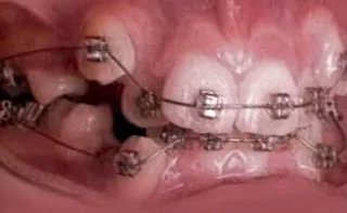 ΑΠΙΣΤΕΥΤΟ VIDEO: Δείτε σε γρήγορη κίνηση πως τα σιδεράκια ισιώνουν τα δόντια…